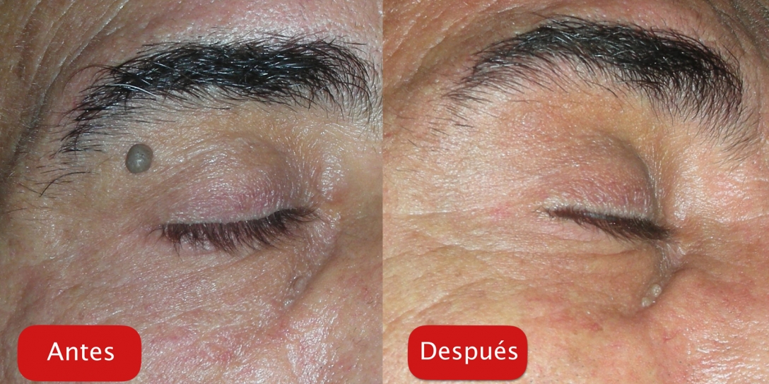 Resultados - Tratamiento plataforma DEKA eliminacion verruga antes y depues